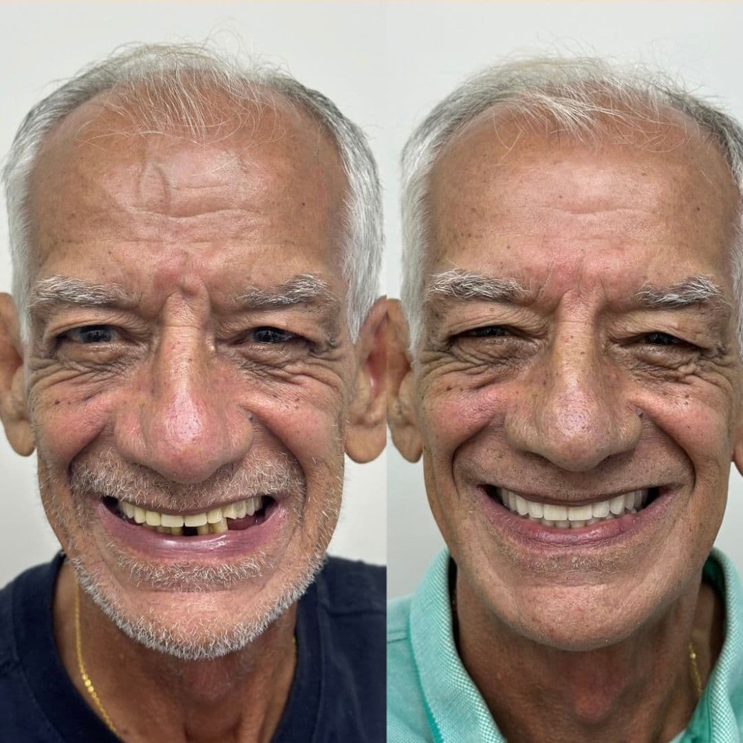 protese-dentaria-1-doutor-ricardo-souza
