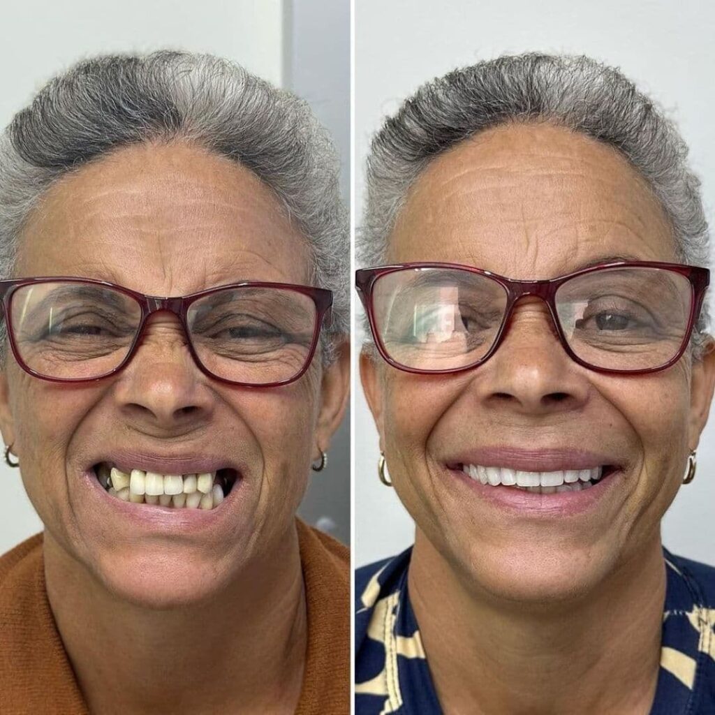 protese-dentaria-2-ero-odontologia