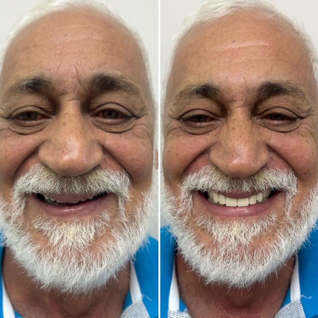 protese-dentaria-3-ero-odontologia