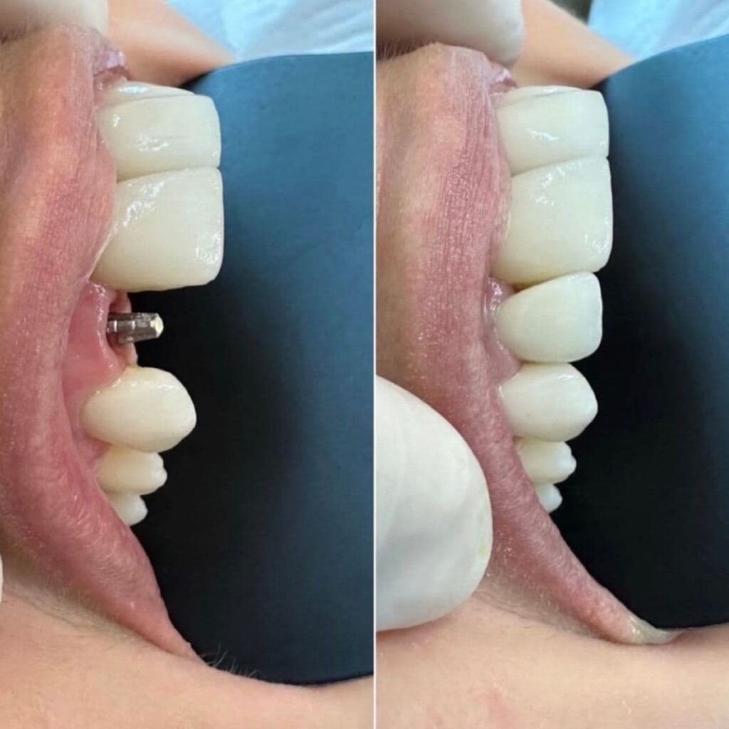 protese-dentaria-4-ero-odontologia